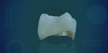 Porcelain Fused to Gold Crown*